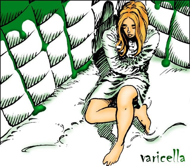 Varicella